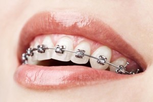 😬🦷Tout savoir sur les élastiques et l'appareil dentaire