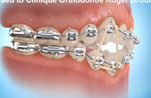 Port d'élastiques en orthodontie